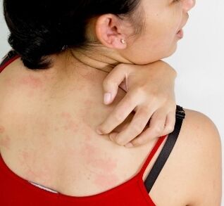 Granulomas on the body - symptoms of the presence of parasites