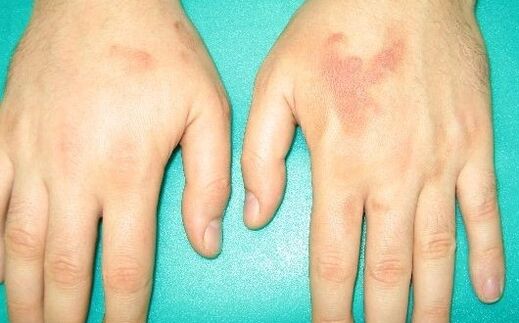 Hand joint pain can be a symptom of parasites