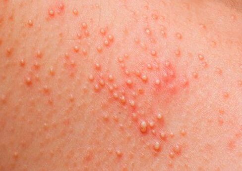 If the body is infected with parasites, skin allergies appear. 