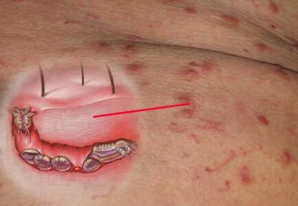 Scabies mites under human skin