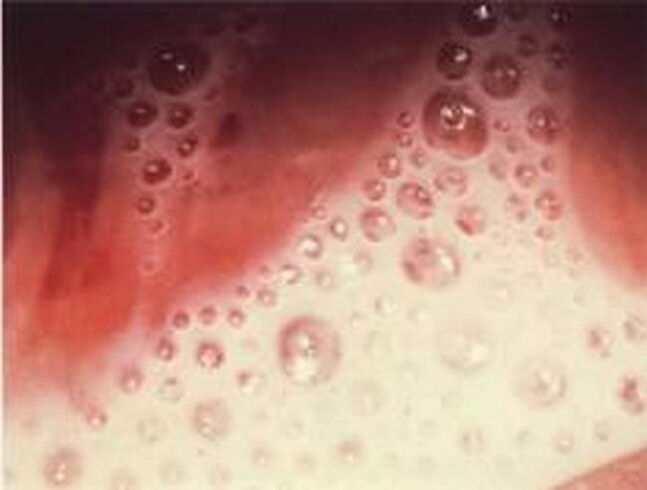 foamy secretions with protozoa