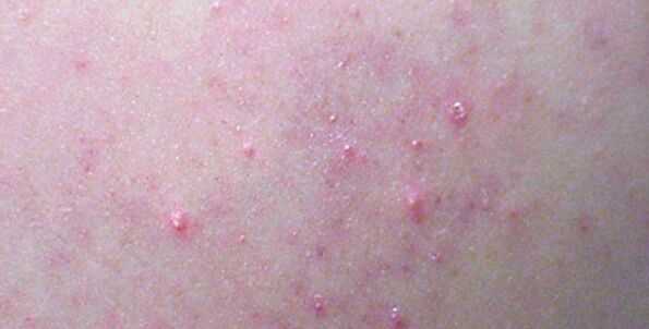 A rash on the body can be a sign of helminth disease