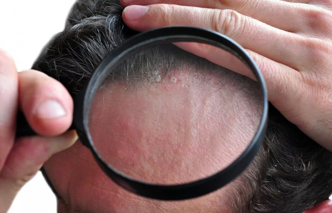 Sebum