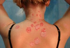 infection